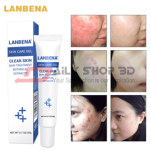 Lanbena EGF Remover Scar Cream Acne Treatment Blackhead Whitening Skin Care